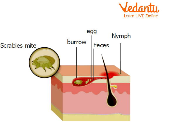Scabies Under the Skin