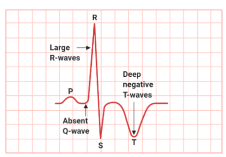 ECG Wave Representation